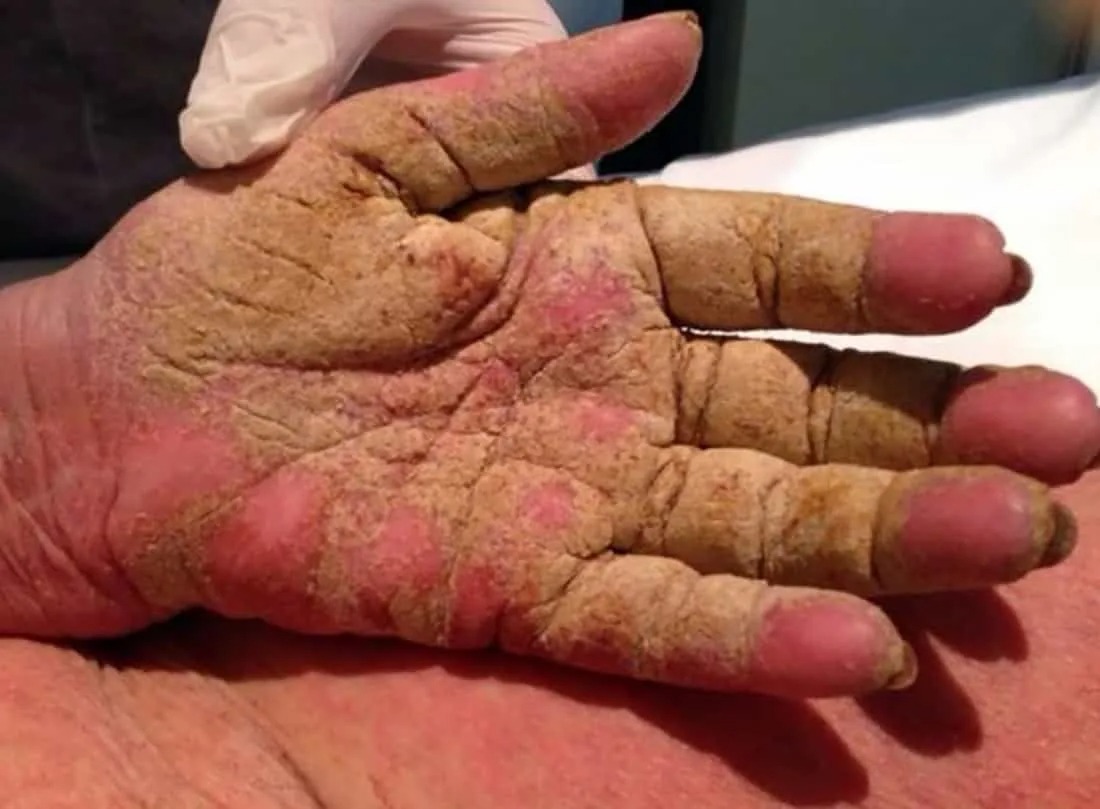 Hospital Regional mantiene controlado brote de sarna noruega